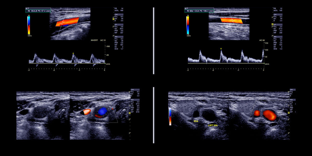 Evento Ecocolordoppler Evento Ecocolordoppler