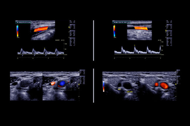 Evento Ecocolordoppler Evento Ecocolordoppler