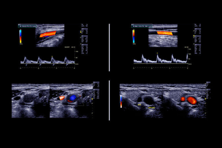 Evento Ecocolordoppler
