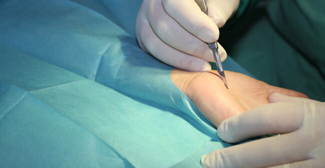 Intervento Tunnel Carpale ntervento Tunnel Carpale