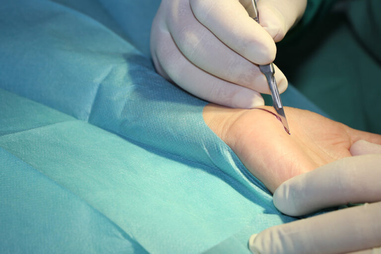 ntervento Tunnel Carpale